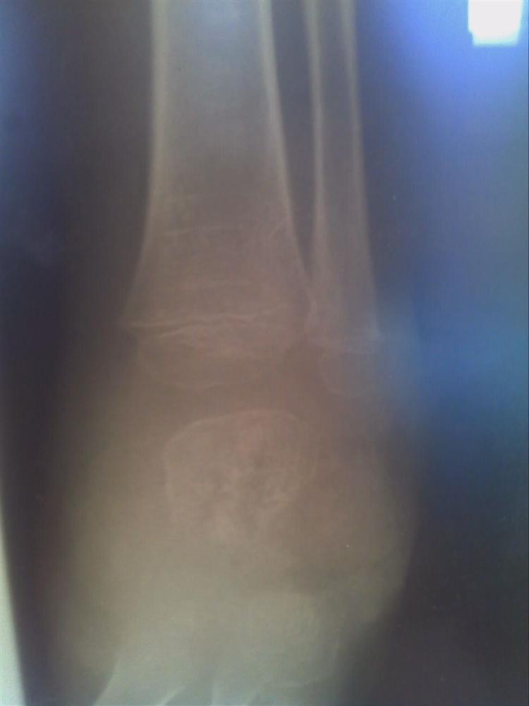 Amputations Trauma Orthobullets